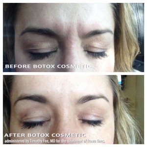 Botox® in Jacksonville & Fleming Island, FL