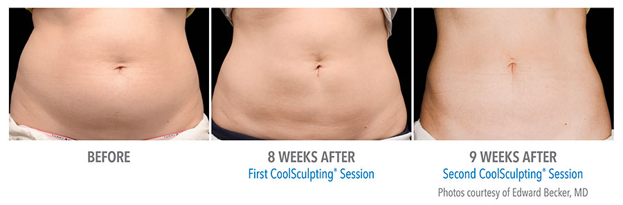 CoolSculpting® Before and After Pictures in Jacksonville & Fleming Island, FL