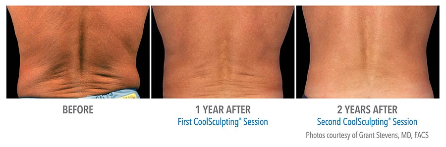 CoolSculpting® Before and After Pictures in Jacksonville & Fleming Island, FL