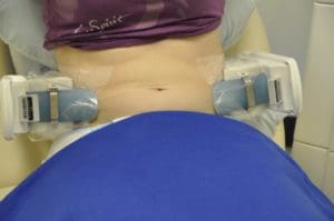 CoolSculpting® Before and After Pictures Jacksonville & Fleming Island, FL