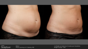 CoolSculpting® Before and After Pictures Jacksonville & Fleming Island, FL