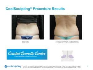 CoolSculpting® Before and After Pictures Jacksonville & Fleming Island, FL