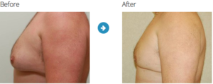 Gynecomastia Before and After Pictures Jacksonville & Fleming Island, FL