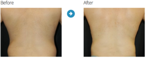 Gynecomastia Before and After Pictures Jacksonville & Fleming Island, FL