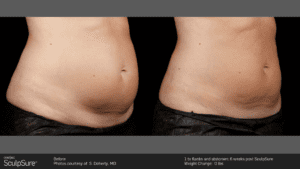 SculpSure® Before and After Pictures Jacksonville & Fleming Island, FL