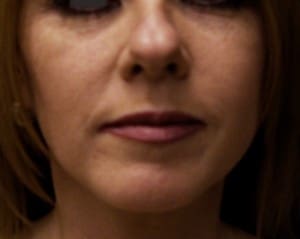 Rhinoplasty in Jacksonville & Fleming Island, FL