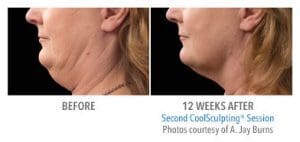 CoolSculpting® Before and After Pictures Jacksonville & Fleming Island, FL