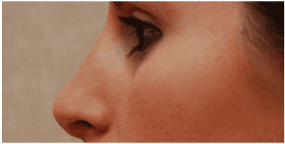 Rhinoplasty in Jacksonville & Fleming Island, FL