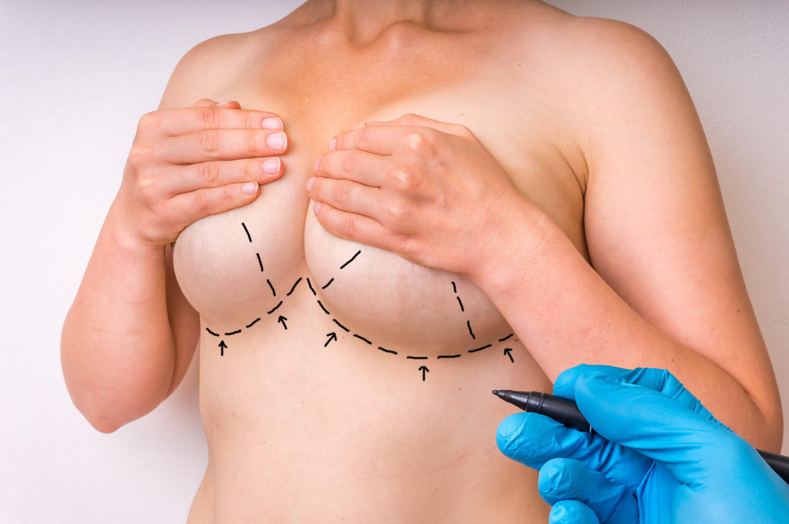 Breast Revision in Jacksonville, FL