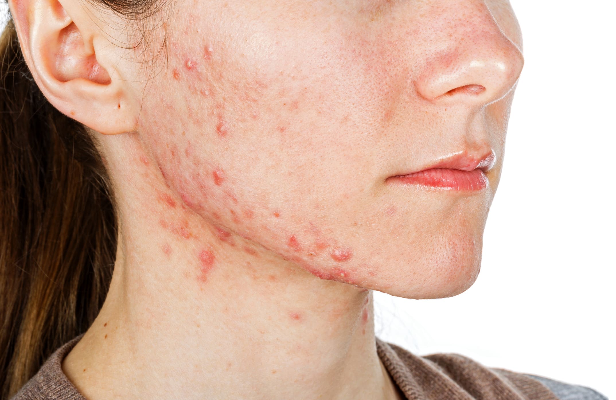 Young girl with skin problem Acne Treatments in Jacksonville, FL